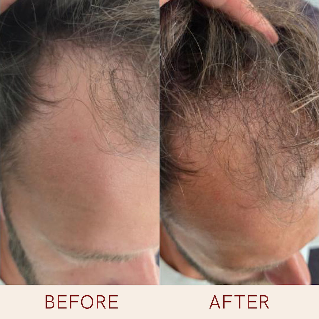 Hair Growth Serum 15 x 5 ml